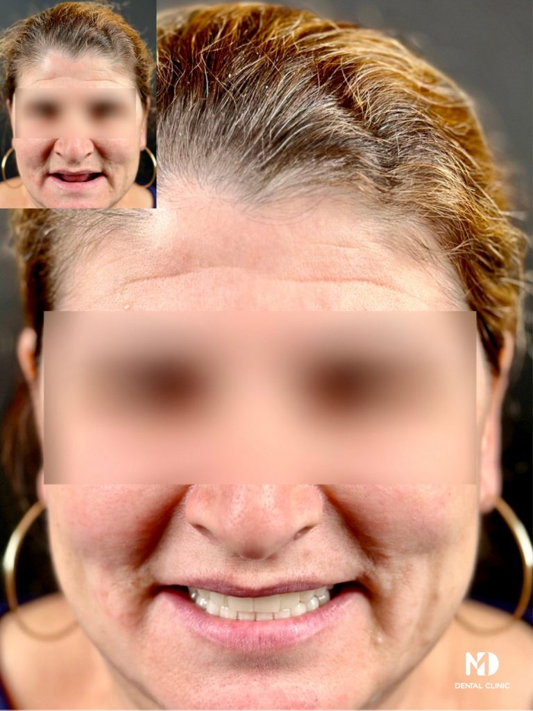 MD Dental - Dinti Ficsi in 24 ore - Implanturi - Before and After